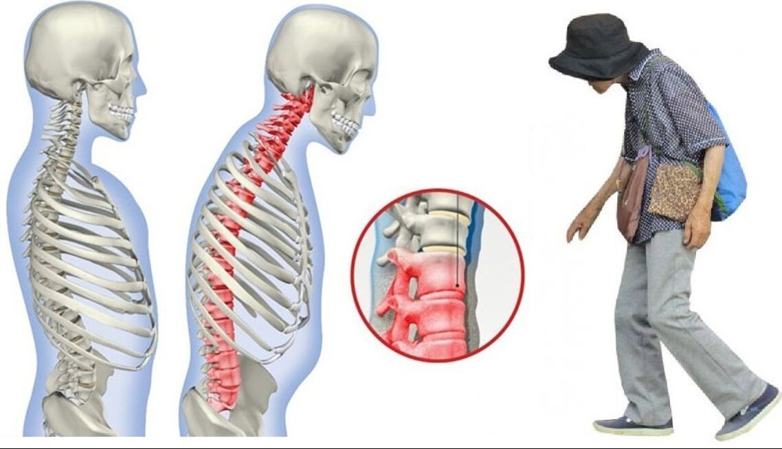 back pain due to ankylosing spondylitis