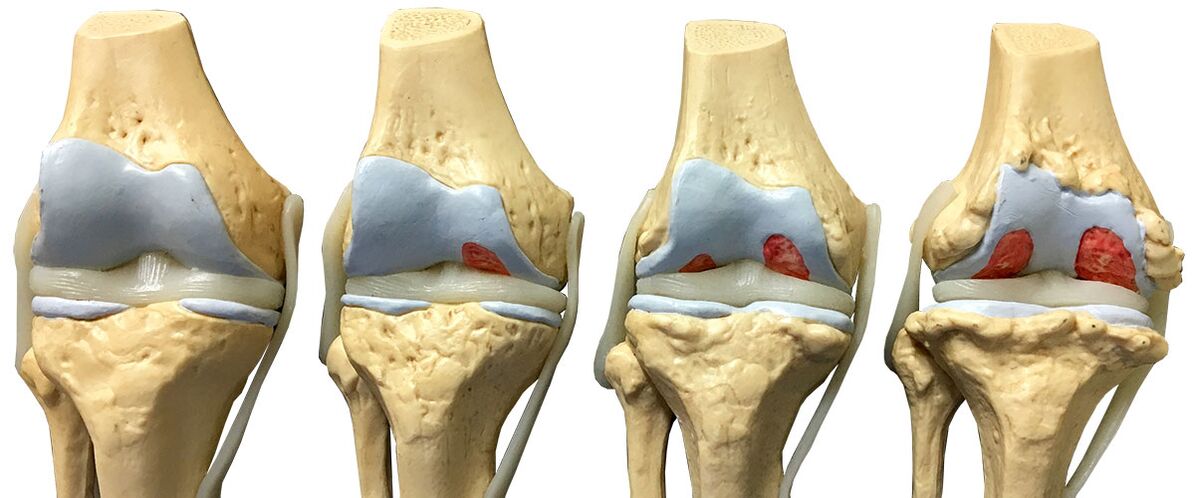 Steps of osteoarthritis of the knee joint