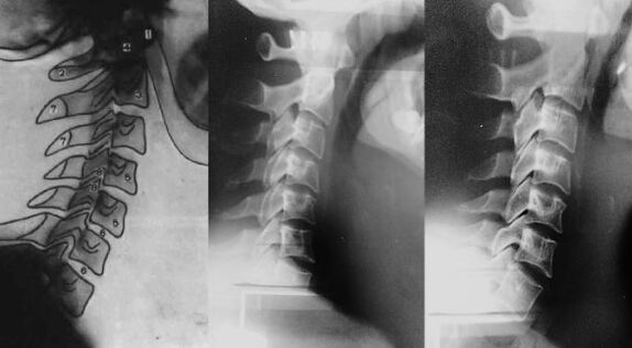 Neck with a displacement of the first cervical vertebra