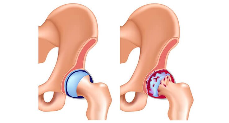 Hip joint articulation